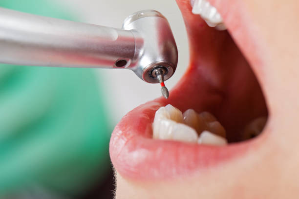 Best Knocked-Out Tooth (Avulsed Tooth) Treatment in Pojoaque, NM